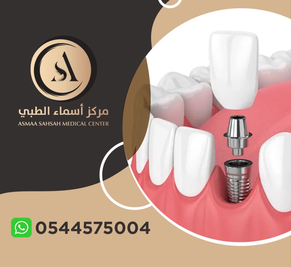 عيادة زراعة اسنان في الشارقة