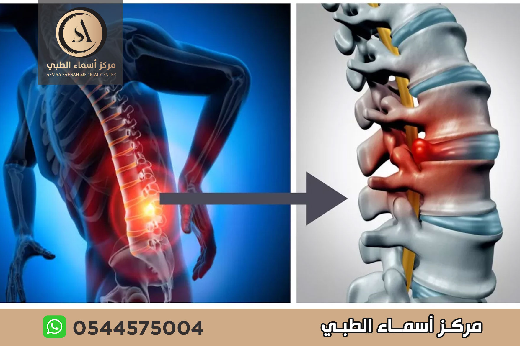 علاج طبيعي للانزلاق الغضروفي في الشارقة