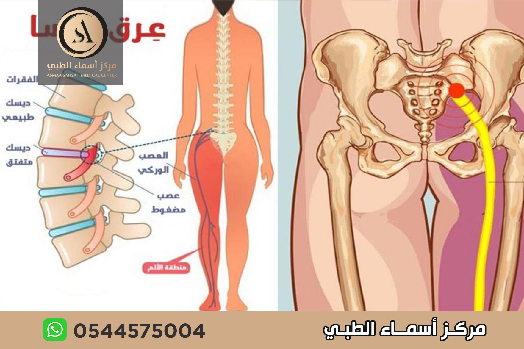 علاج ألم عرق النسا في الشارقة