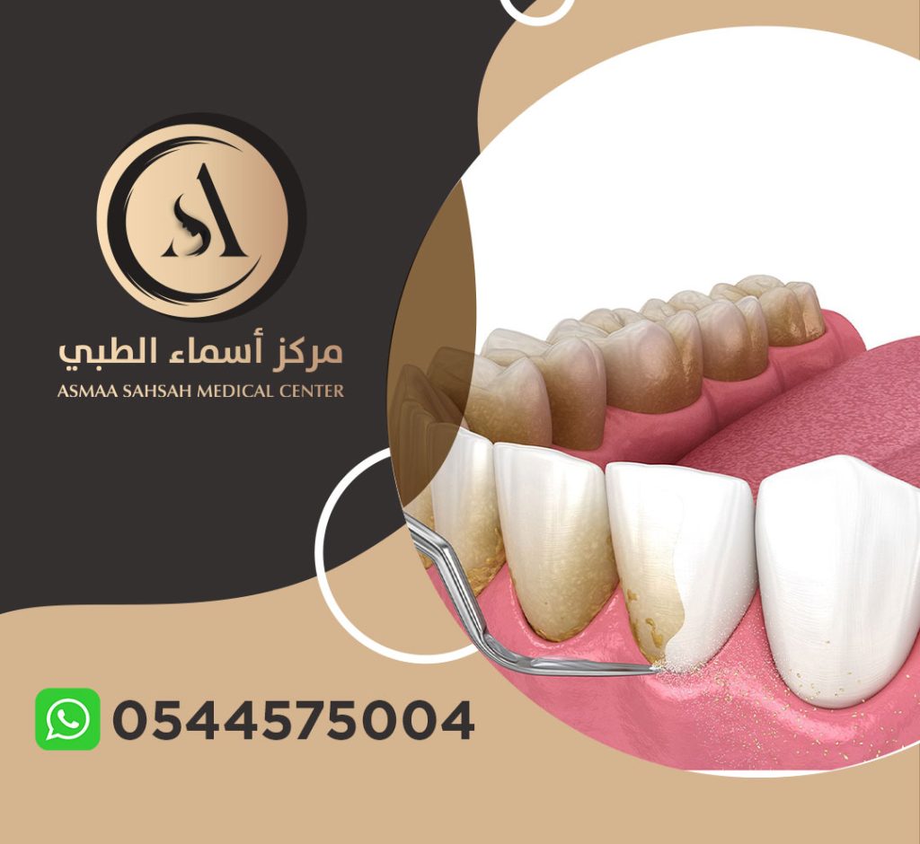 مركز تنظيف اسنان في الشارقة
