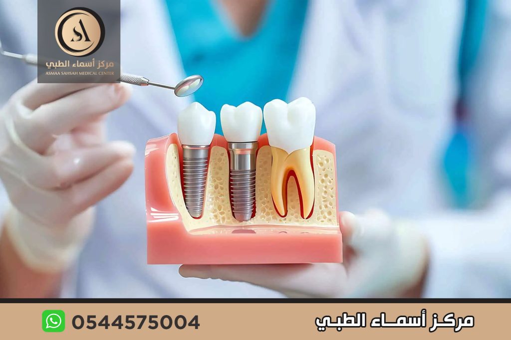 مركز زراعة اسنان في الشارقة