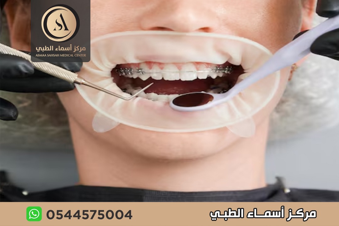فينير الاسنان في الشارقة
