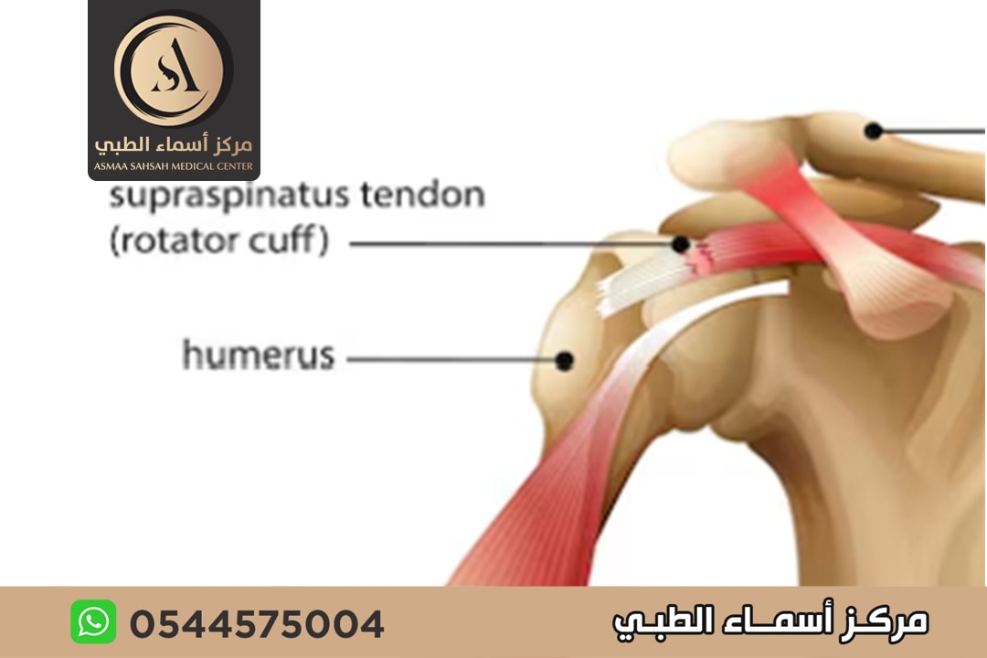 علاج تمزق أربطة الكتف في الشارقة