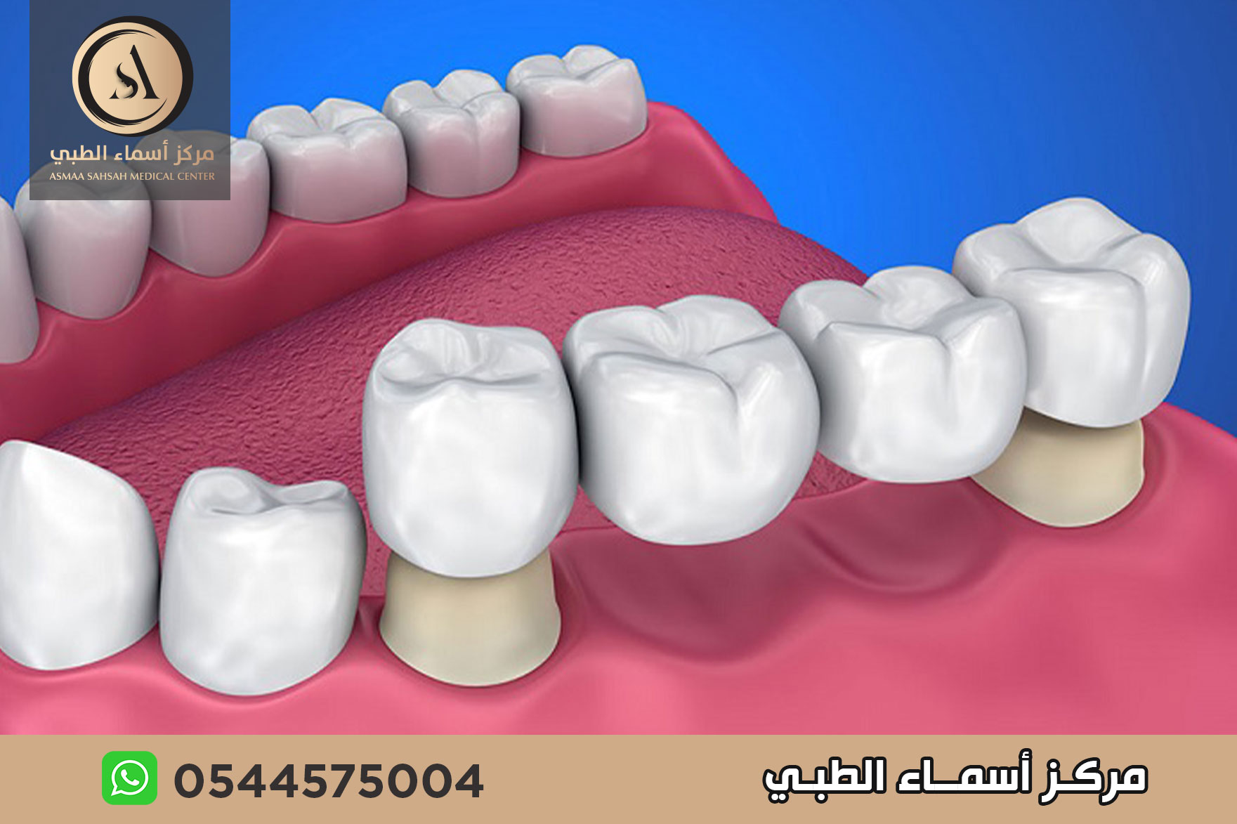 تركيبات الاسنان في الشارقة
